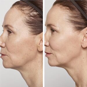 Before and after images of Lyft filler placed in the cheeks -side view of face