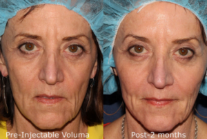 before and after pictures images of Voluma filler in mature face